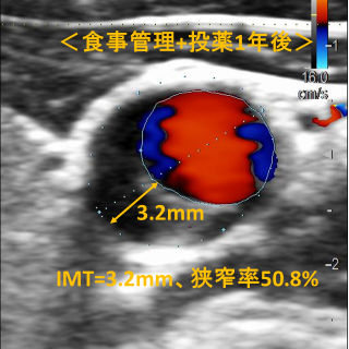 頚動脈狭窄症の改善例 治療1年後